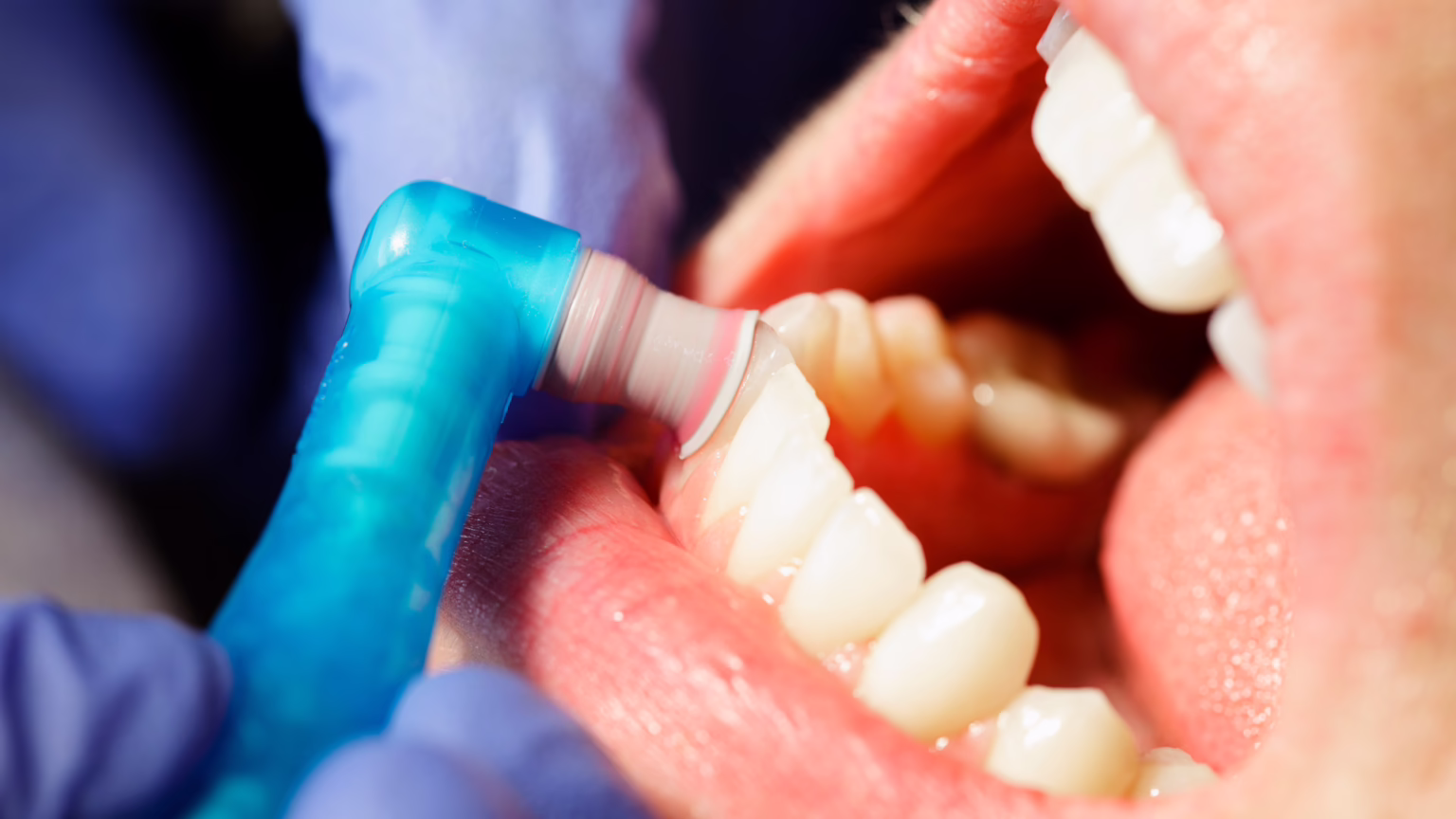 What Types of Dental Cleanings Are There?