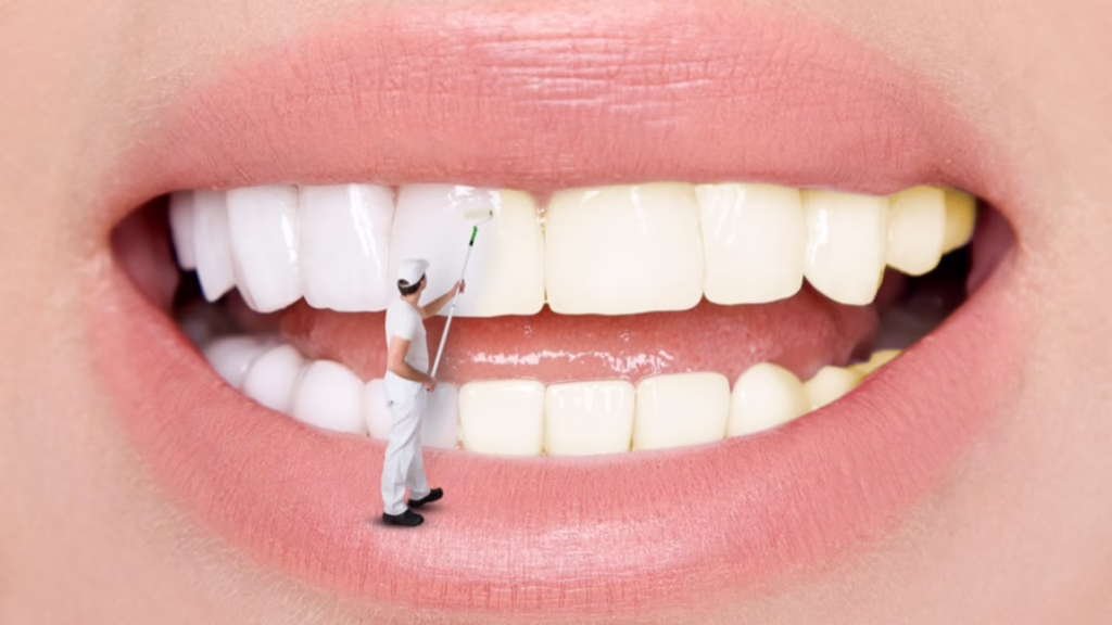 Is Professional Teeth Whitening Treatment Worth It?