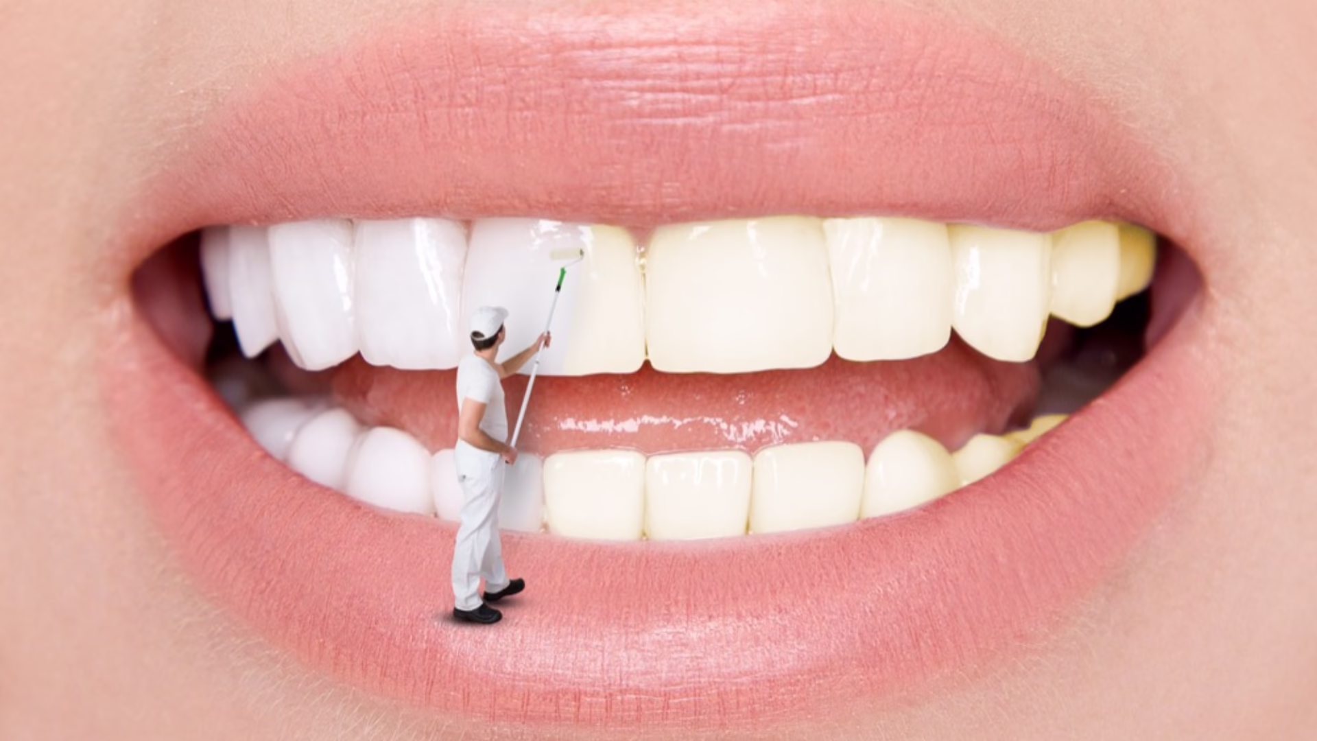 Is Professional Teeth Whitening Treatment Worth It?