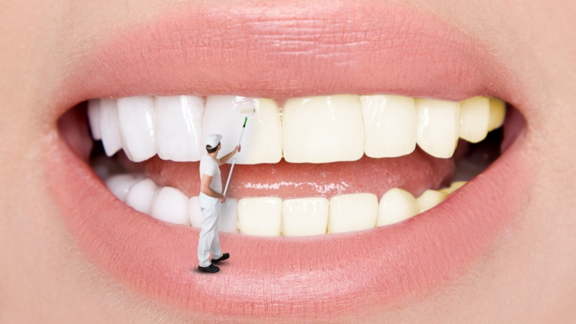 Is Professional Teeth Whitening Treatment Worth It?